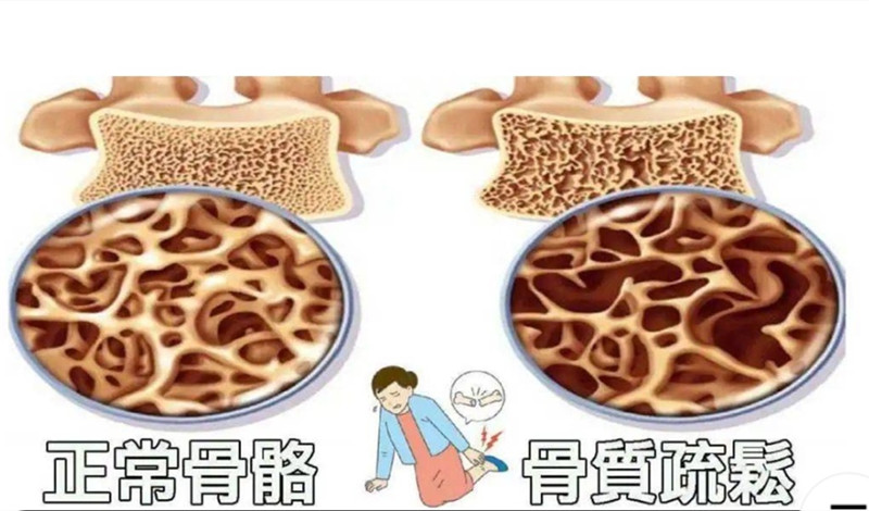 骨質(zhì)疏松危害大.jpg